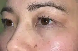 Upper Lid Blepharoplasty (upper eyelid lift)