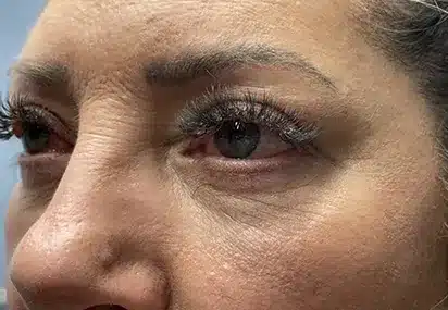 Upper/Lower Lid Blepharoplasty
