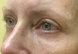 Upper/Lower Lid Blepharoplasty