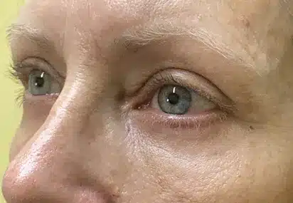 Upper/Lower Lid Blepharoplasty