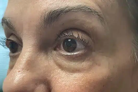 Lower Lid Blepharoplasty (lower eyelid eyelift)