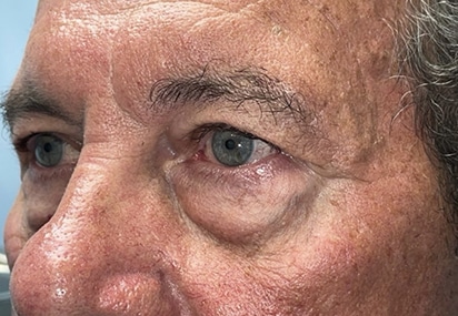 Upper/Lower Lid Blepharoplasty