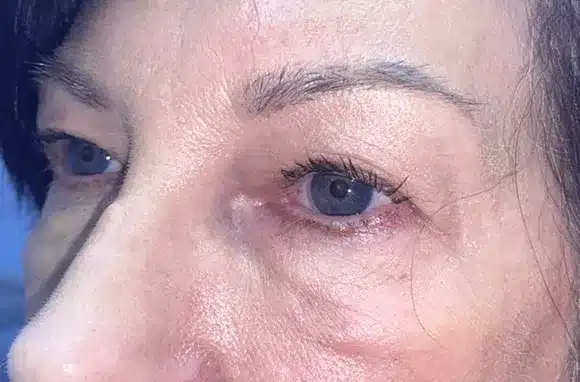 Upper Lid Blepharoplasty (upper eyelid lift)