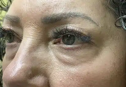 Upper/Lower Lid Blepharoplasty