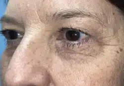 Upper/Lower Lid Blepharoplasty