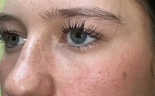 Eyelid Lift (Blepharoplasty/Ptosis Repair)