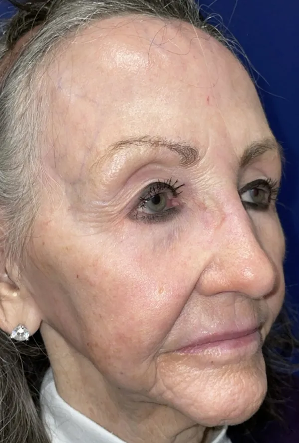 CO2 Laser Resurfacing (wrinkle/line reduction)