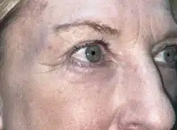 Combination Surgeries (eyelid lift and other)