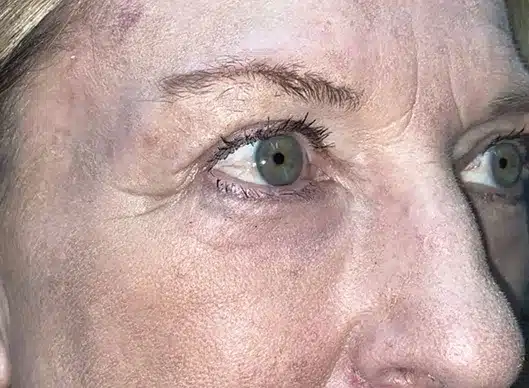 Combination Surgeries (eyelid lift and other)