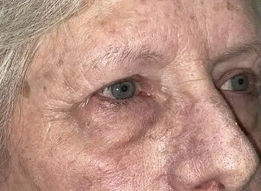 Combination Surgeries (eyelid lift and other)