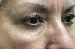 Lower Lid Blepharoplasty (lower eyelid eyelift)