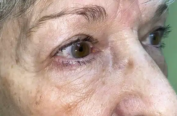 Upper Lid Blepharoplasty (upper eyelid lift)