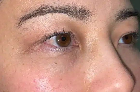 Upper Lid Blepharoplasty (upper eyelid lift)