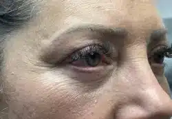 Upper/Lower Lid Blepharoplasty