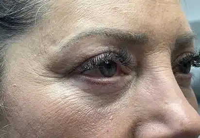 Upper/Lower Lid Blepharoplasty
