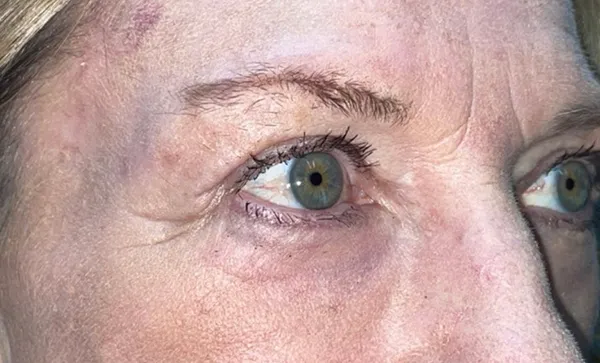Upper/Lower Lid Blepharoplasty