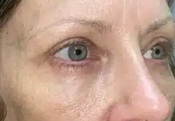 Upper/Lower Lid Blepharoplasty