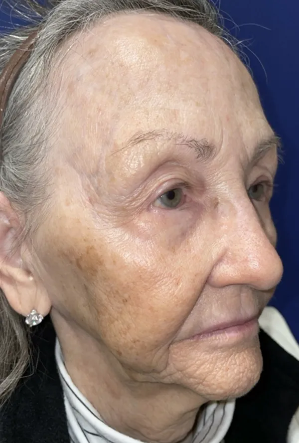 CO2 Laser Resurfacing (wrinkle/line reduction)