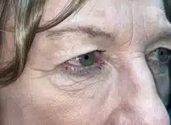Combination Surgeries (eyelid lift and other)