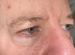 Combination Surgeries (eyelid lift and other)