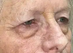 Combination Surgeries (eyelid lift and other)