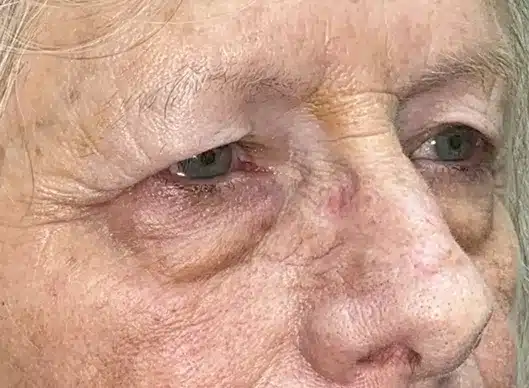 Combination Surgeries (eyelid lift and other)