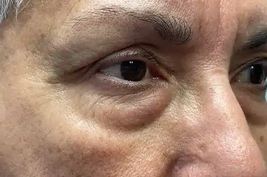 Lower Lid Blepharoplasty (lower eyelid eyelift)