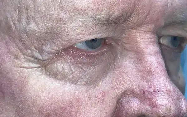 Eyelid Lift (Blepharoplasty/Ptosis Repair)