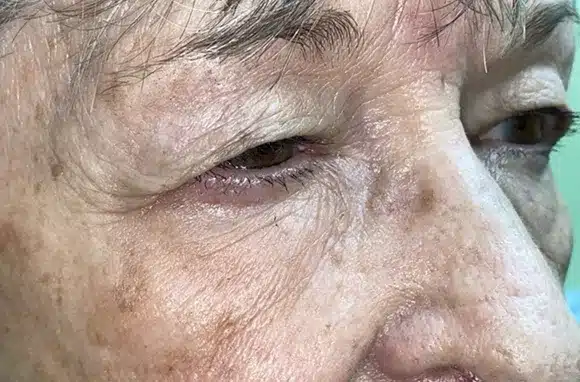 Upper Lid Blepharoplasty (upper eyelid lift)