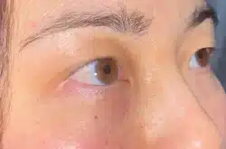 Upper Lid Blepharoplasty (upper eyelid lift)