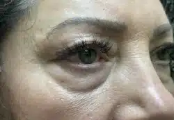 Upper/Lower Lid Blepharoplasty