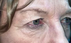 Upper/Lower Lid Blepharoplasty