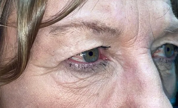 Upper/Lower Lid Blepharoplasty