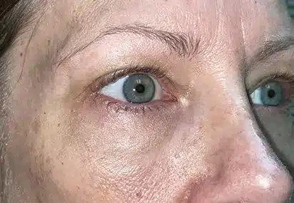 Upper/Lower Lid Blepharoplasty