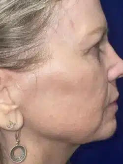 CO2 Laser Resurfacing (wrinkle/line reduction)