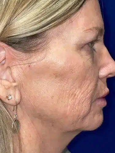 CO2 Laser Resurfacing (wrinkle/line reduction)