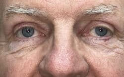 Eyelid Lift (Blepharoplasty/Ptosis Repair)