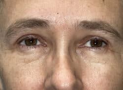 Combination Surgeries (eyelid lift and other)