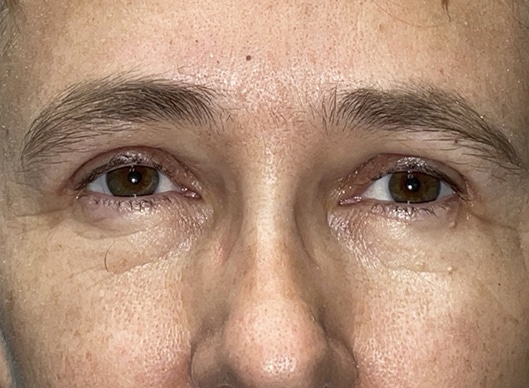 Combination Surgeries (eyelid lift and other)