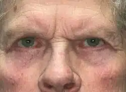 Combination Surgeries (eyelid lift and other)