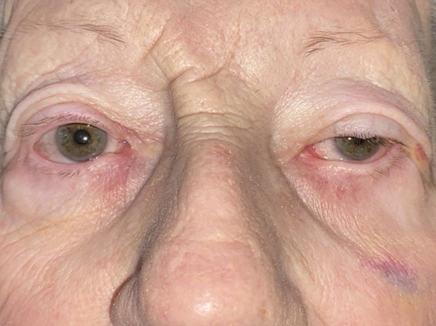 Ectropion, Entropion (Repair of Lower Lid Malposition)