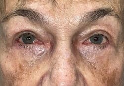 Upper/Lower Lid Blepharoplasty