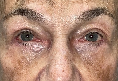 Upper/Lower Lid Blepharoplasty