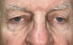 Eyelid Lift (Blepharoplasty/Ptosis Repair)