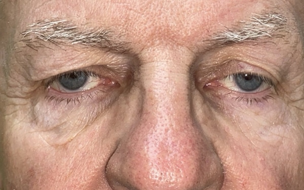 Eyelid Lift (Blepharoplasty/Ptosis Repair)