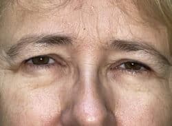 Combination Surgeries (eyelid lift and other)