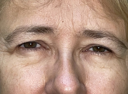 Combination Surgeries (eyelid lift and other)