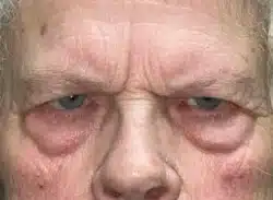 Combination Surgeries (eyelid lift and other)