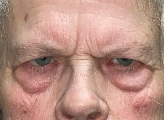 Combination Surgeries (eyelid lift and other)