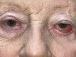 Ectropion, Entropion (Repair of Lower Lid Malposition)